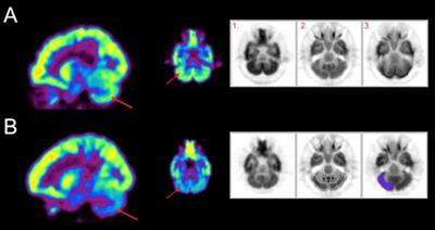 Brain Metabolism During A Lower Extremity Voluntary Movement Task in Children With Spastic Cerebral Palsy